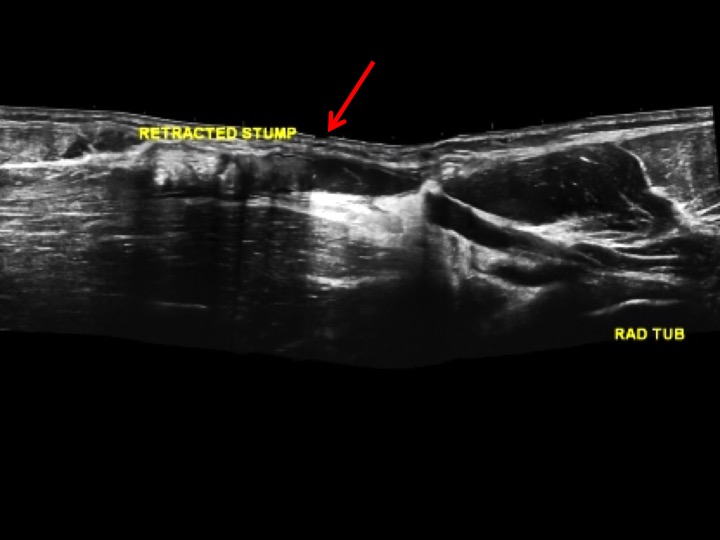 Figure 3 for case distal tendon of biceps brachii ( RID2065 )